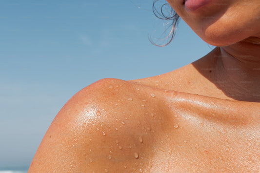 SUMMER ACNE TREATMENT FOR SENSITIVE SKIN