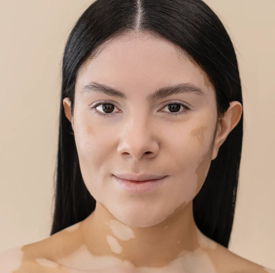 HYPERPIGMENTATION
