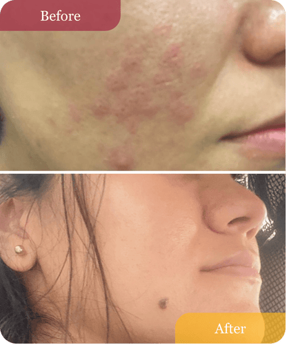 Refillable Clear Confidence Moisturizer Moisturizer (Acne - Prone) - Sensitive Skin Dark Spots Hyperpigmentation uneven tone - Natural Retinol Alternative Moisturizer (Acne - Prone) - BEJOU Skincare