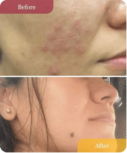 Refillable Clear Confidence Moisturizer Moisturizer (Acne - Prone) - Sensitive Skin Dark Spots Hyperpigmentation uneven tone - Natural Retinol Alternative Moisturizer (Acne - Prone) - BEJOU Skincare